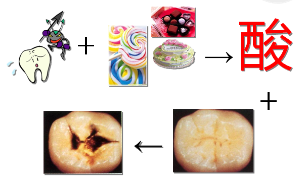 为什么会引发蛀牙?