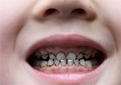 儿童龋齿图片初期图片